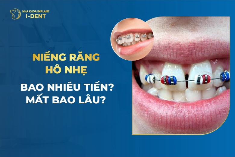 Niềng Răng Hô Là Gì? Quy Trình Và Các Phương Pháp Hiệu Quả