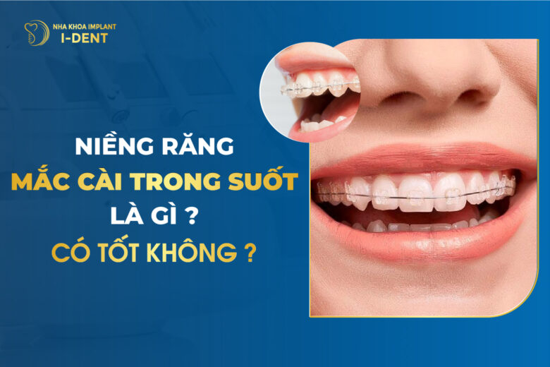 Niềng Răng Mắc Cài Trong Suốt Là Gì? Có Tốt Không?