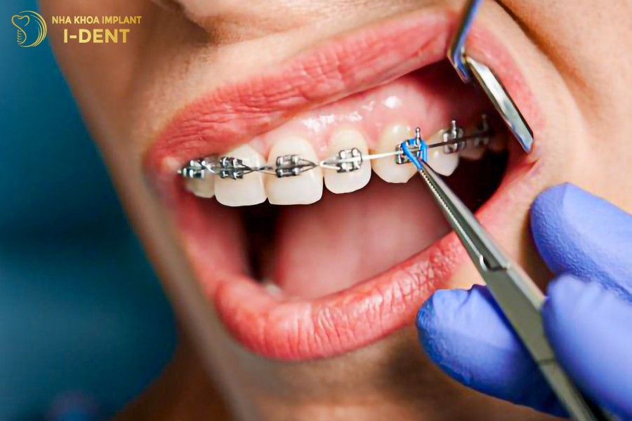 Nieng-rang-1-ham-chu-yeu-duoc-ap-dung-cho-nhung-truong-hop-mom-nhe