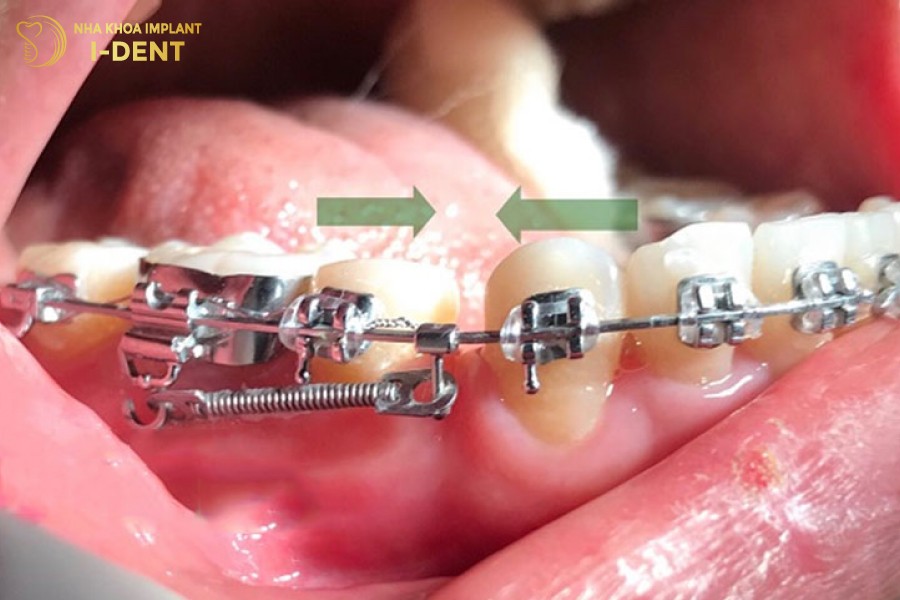 Nieng-rang-can-co-khoang-trong-de-rang-di-chuyen