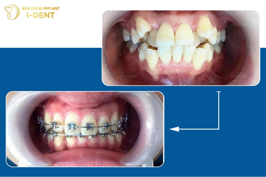 niềng răng khểnh bao nhiêu tiền