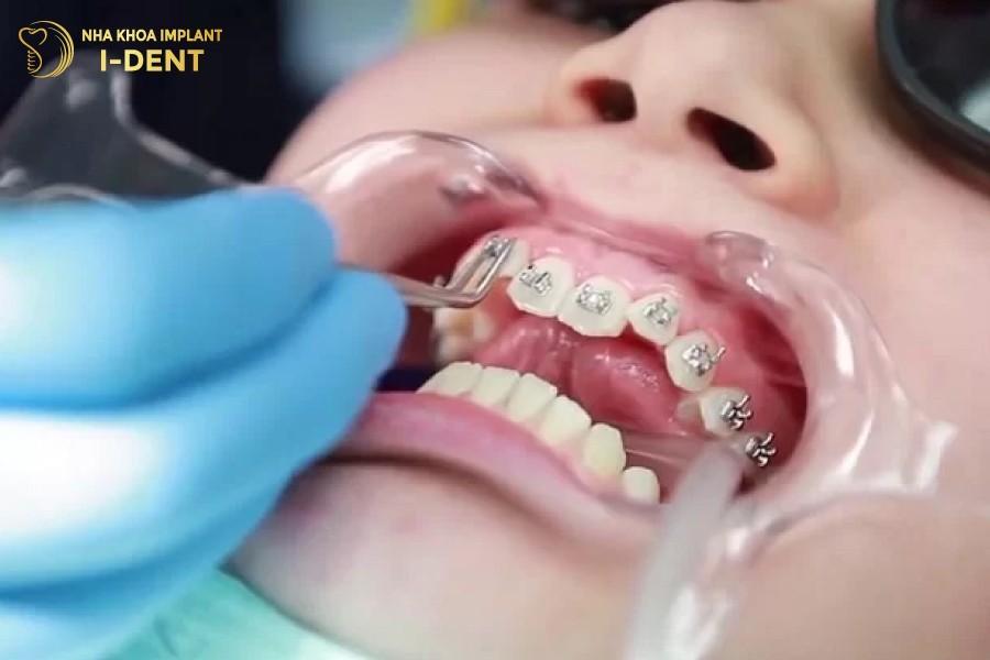 Nieng-rang-mac-cai-kim-loai-hop-ly