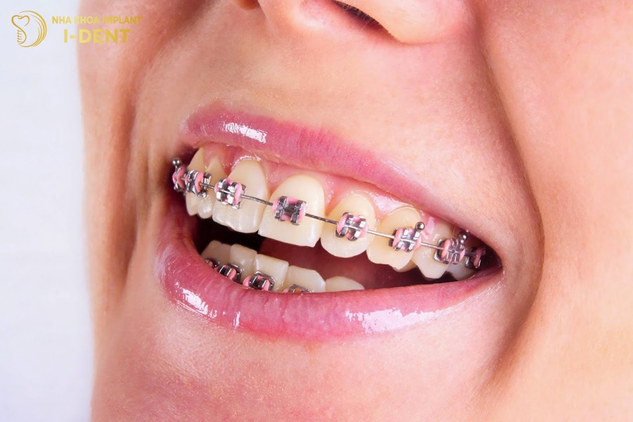 Niềng răng mắc cài tự buộc