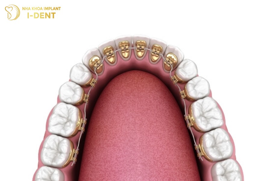 Niềng răng mắc cài mặt lưỡi