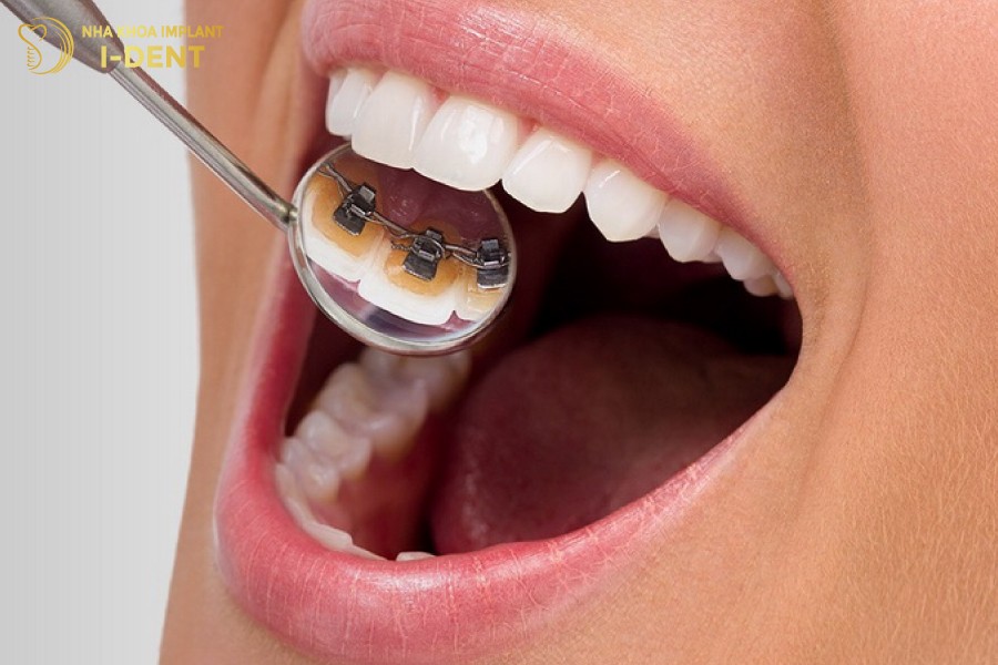 Niềng răng mắc cài mặt lưỡi đem lại tính thẩm mỹ cao
