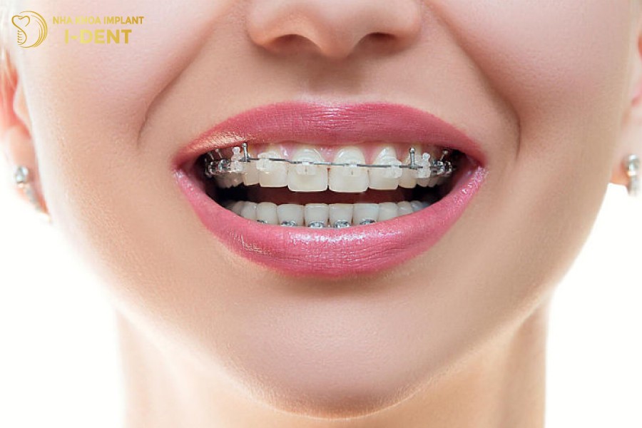 Nieng-rang-mac-cai-trong-suot-su-dung-mac-cai-lam-tu-su-hoac-pha-le