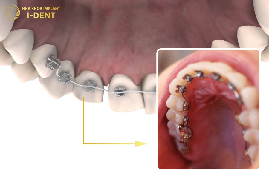 niềng răng mắc cài phía trong phù hợp với các tình trạng sai lệch