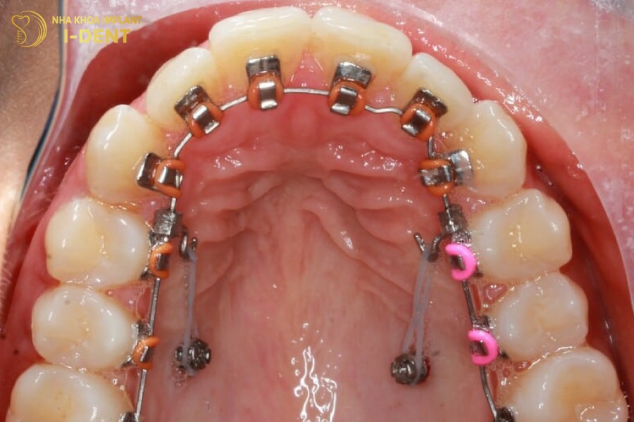 niềng răng mặt trong là gì