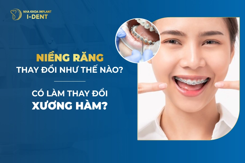Niềng răng có thay đổi xương hàm hay khuôn mặt không?