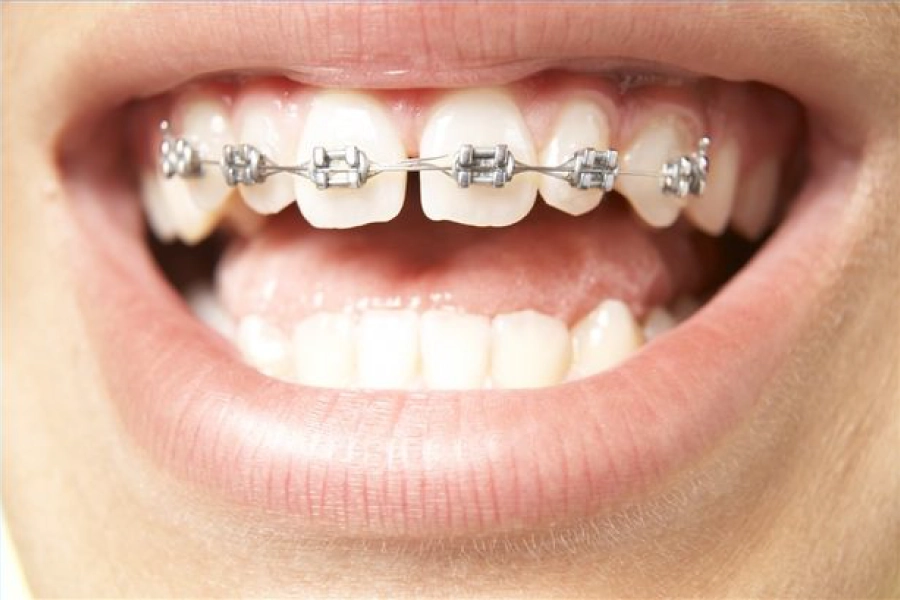  Niềng răng thưa bằng mắc cài kim loại