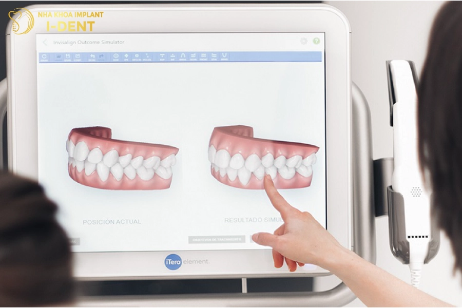 Niềng răng trong suốt có thể biết trước kết quả, qua phần mềm 3D