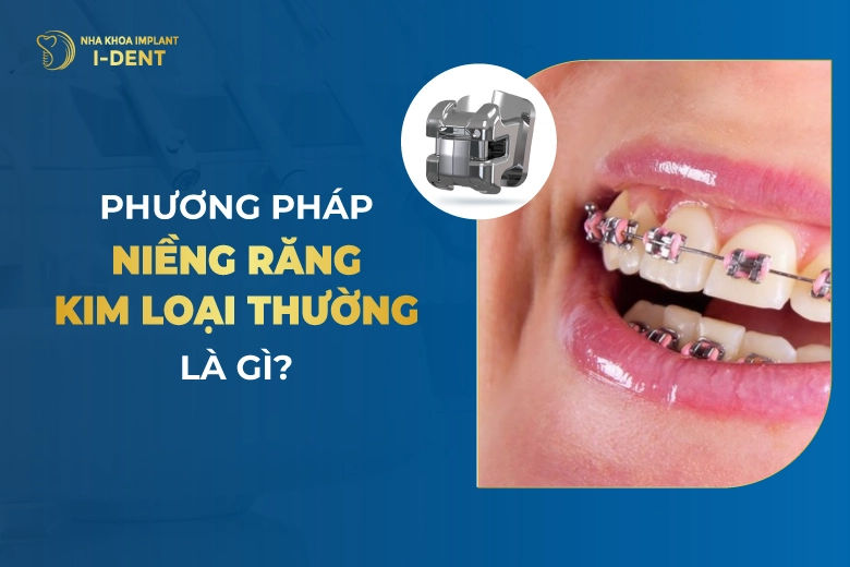 Phương Pháp Niềng Răng Kim Loại Thường Là Gì?