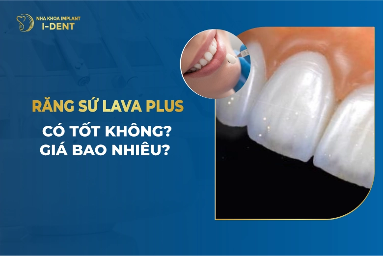 Răng Sứ Lava Plus Là Gì? Ưu Nhược Điểm? Giá Bao Nhiêu?