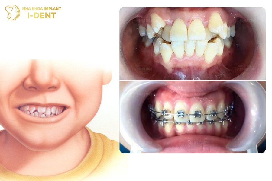 Rang-moc-chen-chuc-khong-co-khoang-trong-xe-dich-la-truong-hop-can-nho-rang-truoc-khi-nieng