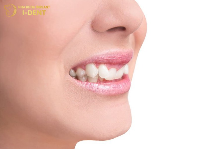 niềng răng khấp khểnh bao nhiêu tiền