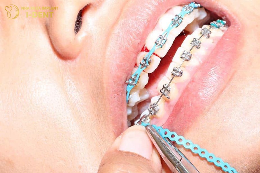 Rang-thua-qua-nhieu-thi-bat-buoc-phai-nieng-ca-2-ham