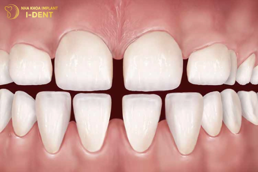 Răng thưa tạo nên các khoảng hở lớn giữa các răng