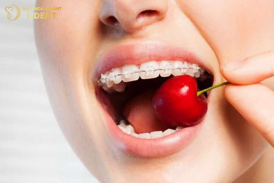 niềng răng mặt lưỡi khó vệ sinh răng miệng