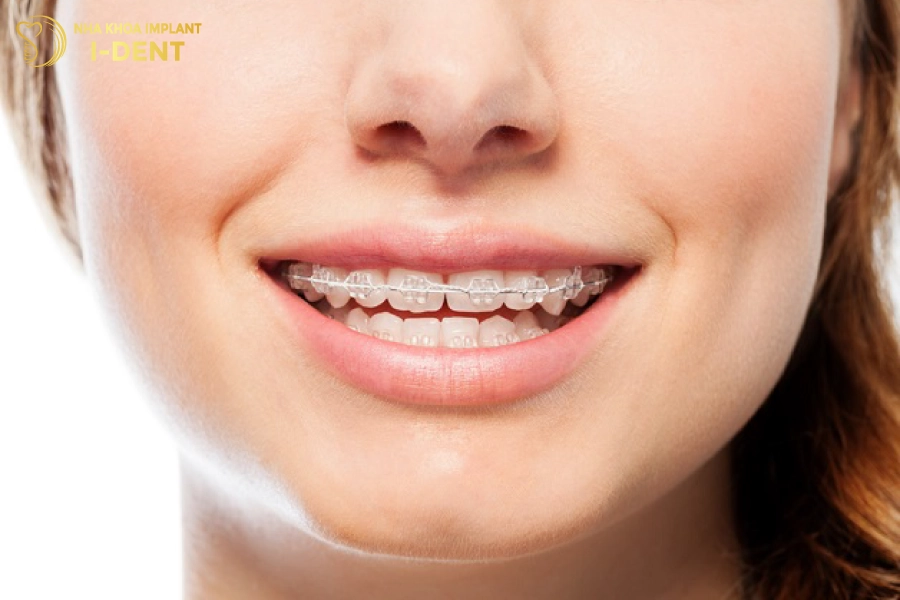 Thời gian niềng răng thưa ở mỗi người là không giống nhau