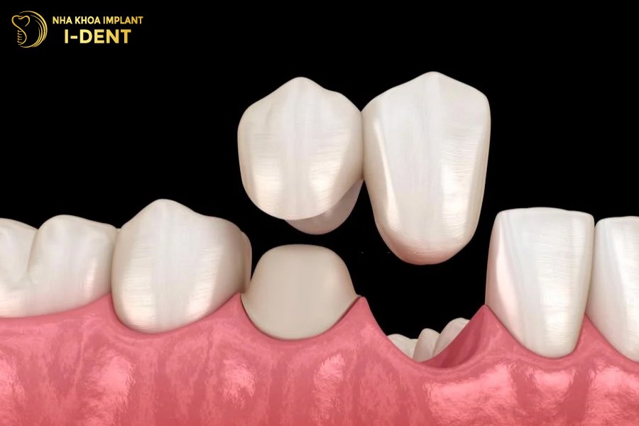 bọc răng sứ bắc cầu