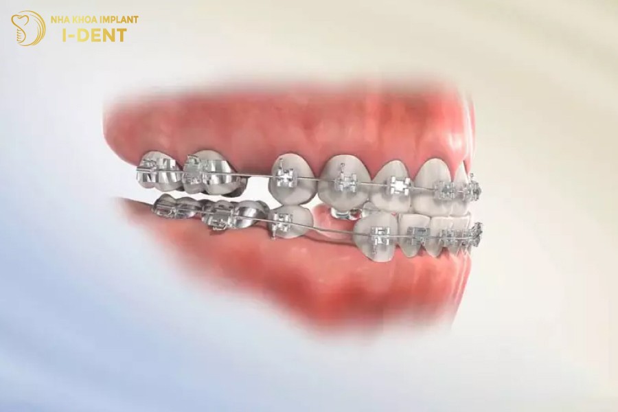 Truong-hop-lech-khop-can-can-nho-rang-de-dam-bao-ket-qua-sau-nieng