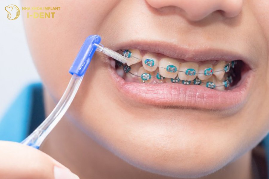 Ve-sinh-rang-mieng-ky-luong-se-giup-qua-trinh-nieng-rang-thuan-loi