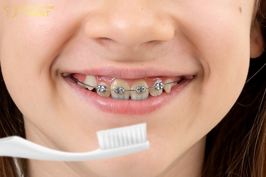 Chăm sóc răng đúng cách giúp duy trì kết quả niềng răng và phòng ngừa sâu răng.