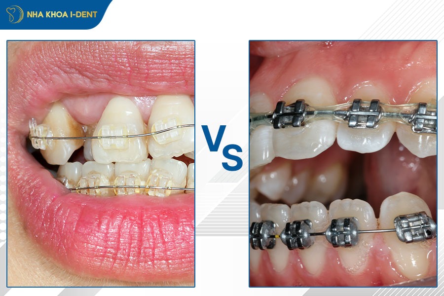 chăm sóc răng niềng