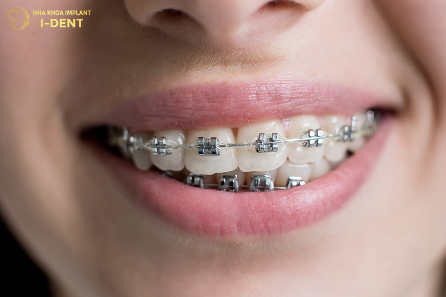 niềng răng có tác hại gì