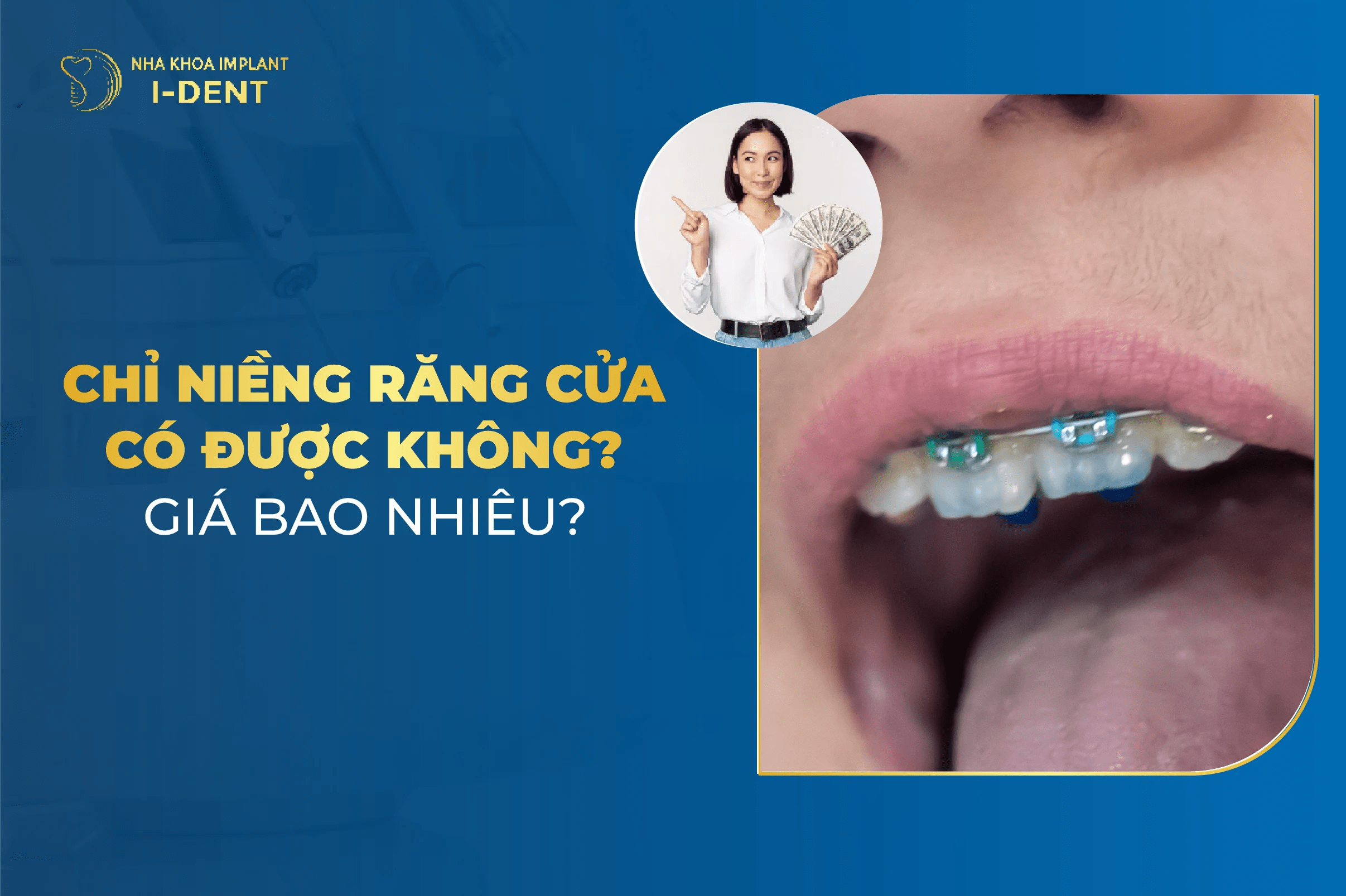 Chỉ Niềng 2 Răng Cửa Có Được Không? Giá Bao Nhiêu?