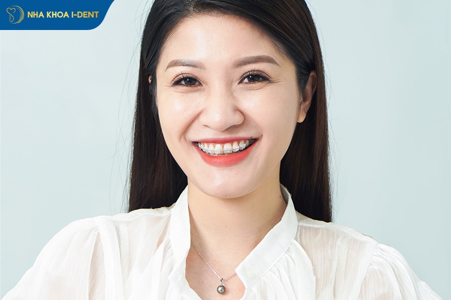 niềng kéo răng hàm