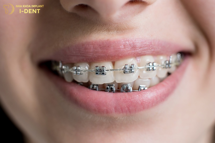 niềng răng bao nhiêu tiền 1 hàm