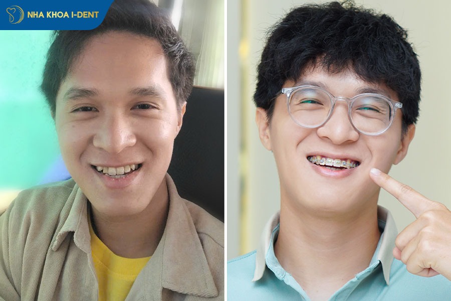 niềng răng chỉnh hàm