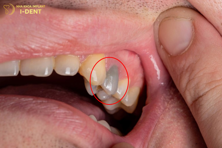 những tác hại của niềng răng