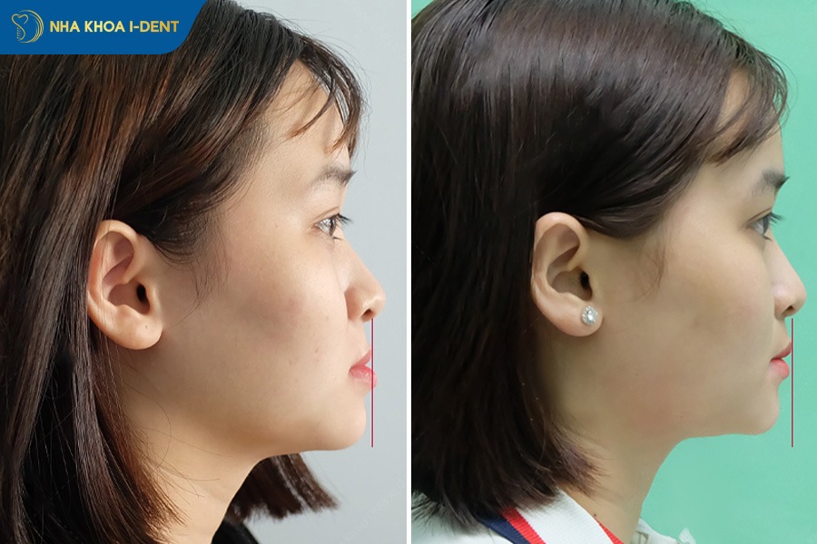 niềng răng có giúp hàm nhỏ lại