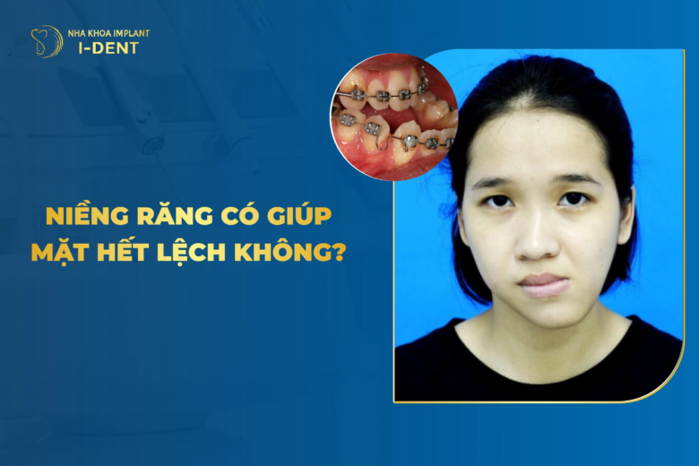 Niềng Răng Có Giúp Mặt Hết Lệch Không?