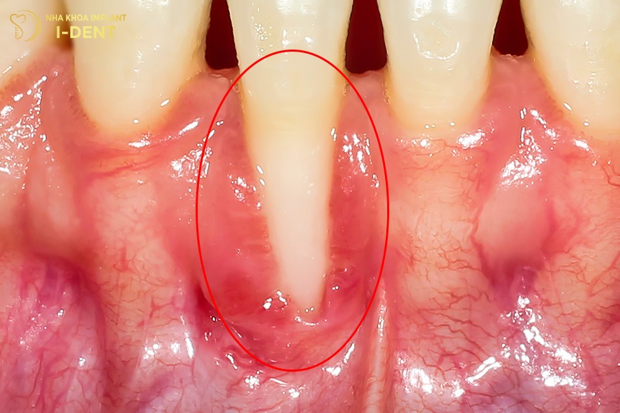 niềng răng có hại không