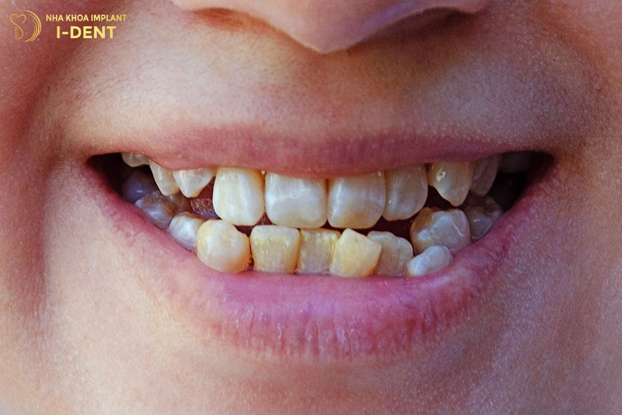 niềng răng có hại gì không