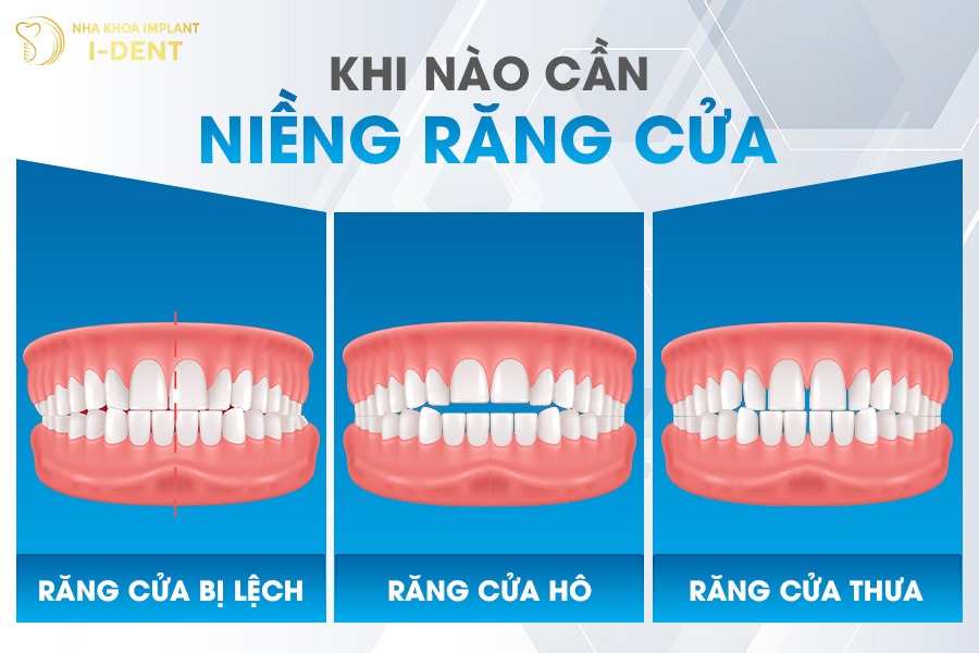 Khi nào cần niềng răng cửa