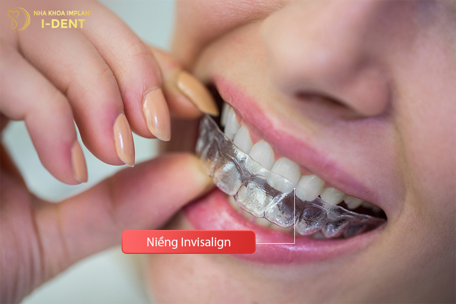Niềng răng trong suốt Invisalign