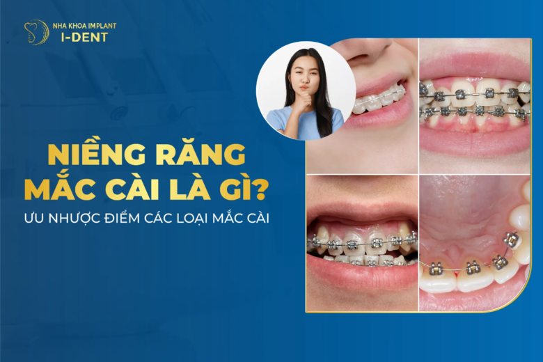 Niềng Răng Mắc Cài Là Gì? Ưu Nhược Điểm Các Loại? Giá Niềng