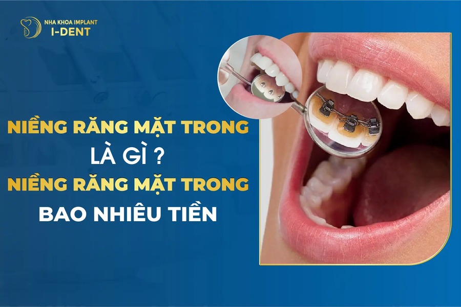 Niềng Răng Mắc Cài Mặt Trong (Mặt Lưỡi) Là Gì? Giá Bao Nhiêu?