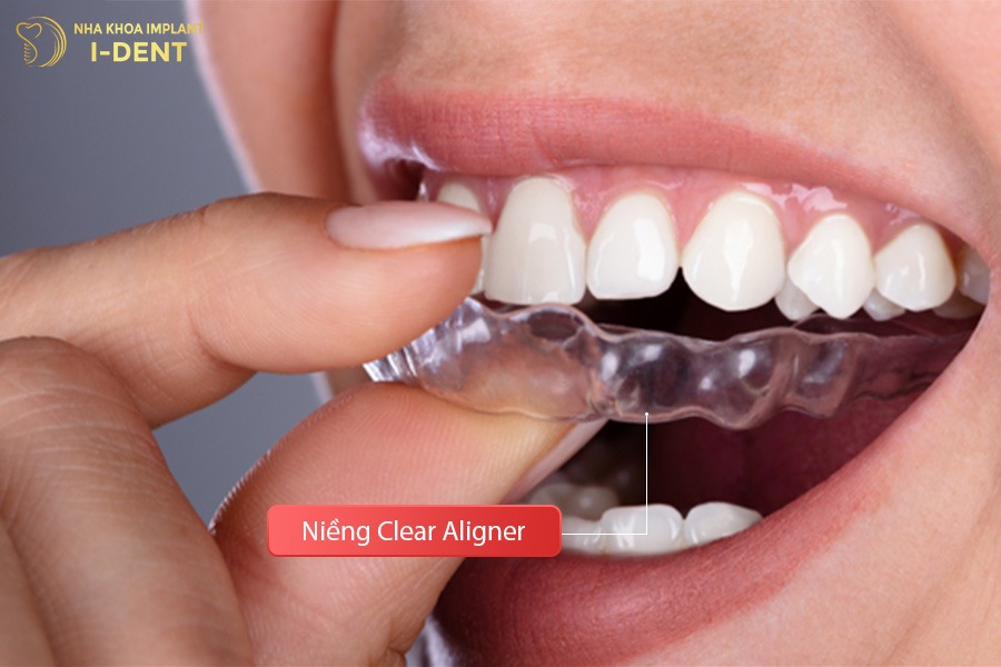 Niềng răng trong suốt Clear Aligner