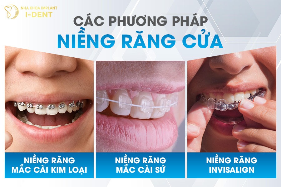 phương pháp niềng răng cửa 