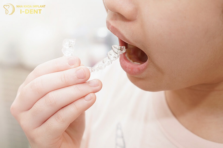 Phương pháp niềng răng trẻ em invisalign.