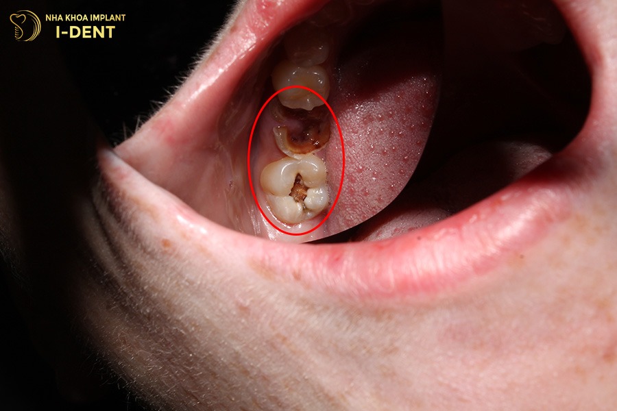 niềng răng có tốt không