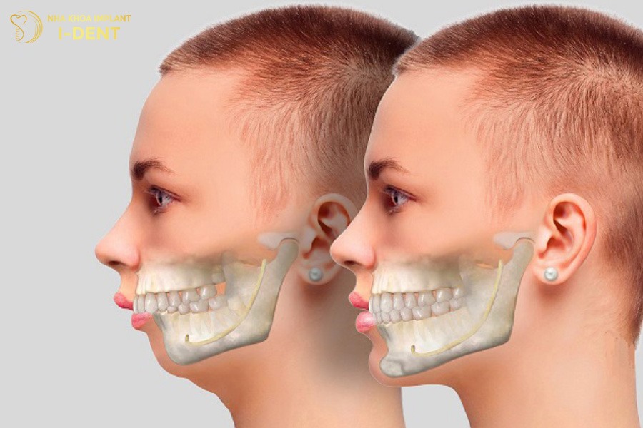 tác hại niềng răng