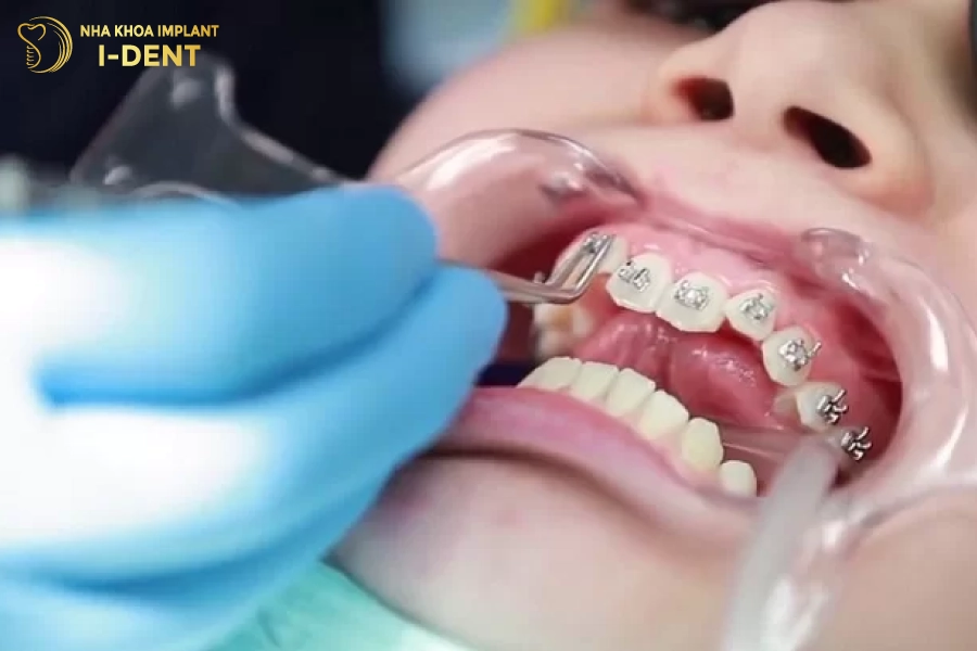 thời gian niềng răng phụ thuộc vào mức độ khiếm khuyết của răng