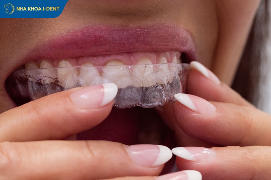 vệ sinh răng niềng đúng cách