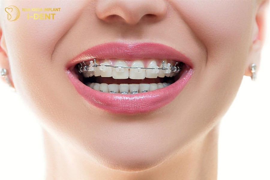 Niềng răng mắc cài pha lê